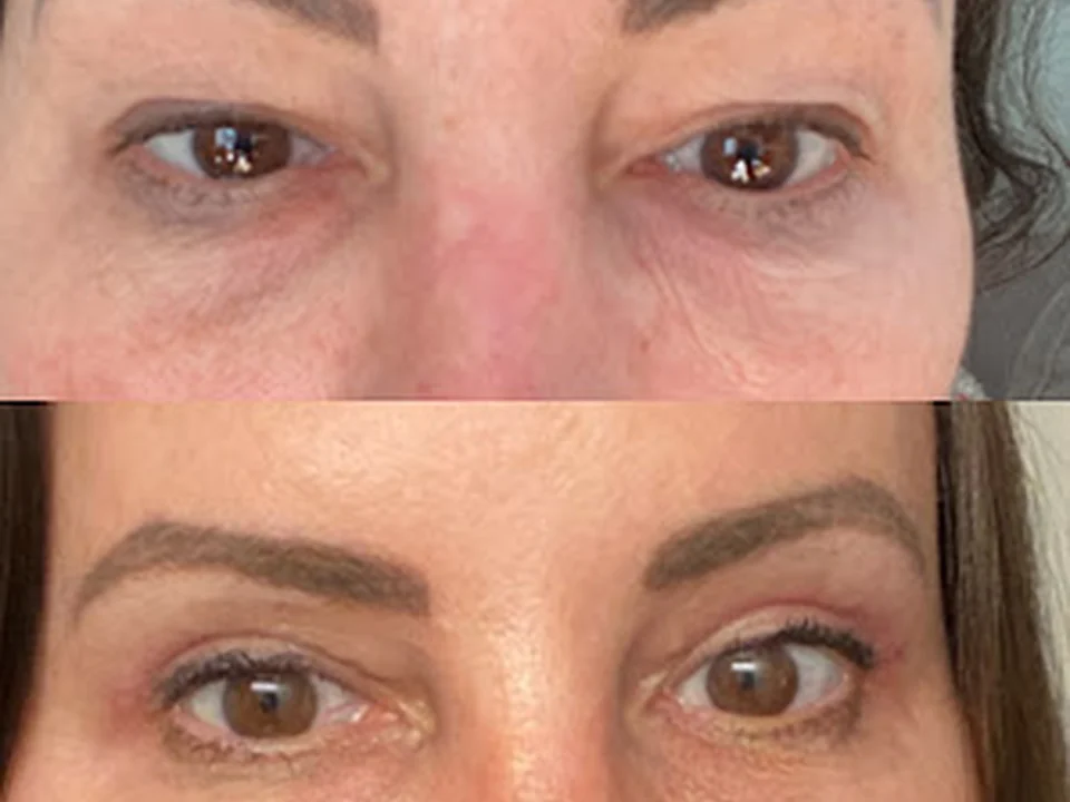 Dr. Mitesh Kapadia - Eyelid Surgery, Botox & Restylane